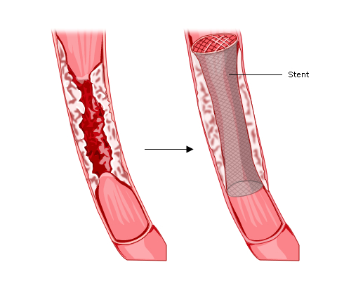 Fig 1 An oesophageal stent