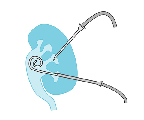 Percutaneous Nephrostomy