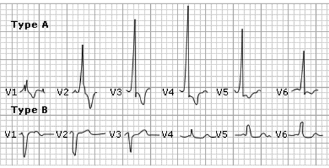 Wolff Parkinson White Syndrome - MRCEM Part 